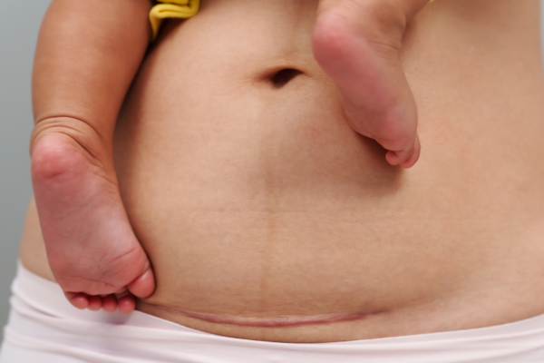 A royalty-free image which depicts a women's healed c-section scar. She is holding a baby, whose feet and laying above her scarring.